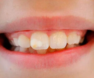 cárie hipoplasica dentária