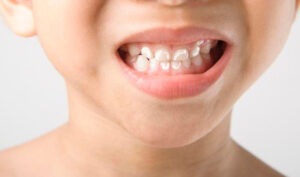 fluorose odontopediatria dentista de criança