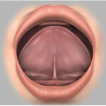 frenectomia lingual