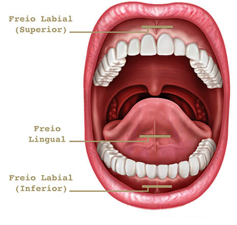 frenectomia labial 
