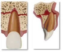 dente osso queda fratura alveolar porto alegre