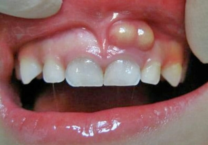 abscesso dentário fistula