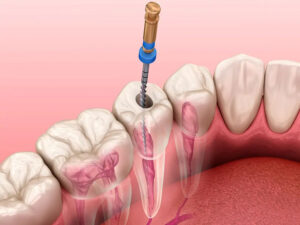 abscesso dentario tratamento de canal