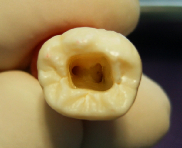 endodontia tratamento de canal odontopediatra