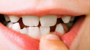 exodontia extração de dente
