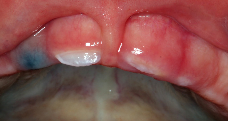 hematoma erupção dente bolinha roxa