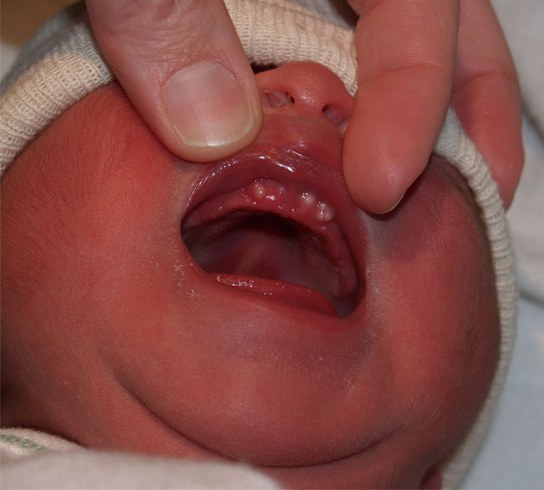 Pérolas de Epstein do recém-nascido: causas, sintomas e tratamento -  Dentalis