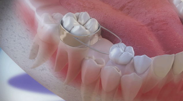 aparelho ortodontico infantil banda alça arco lingual