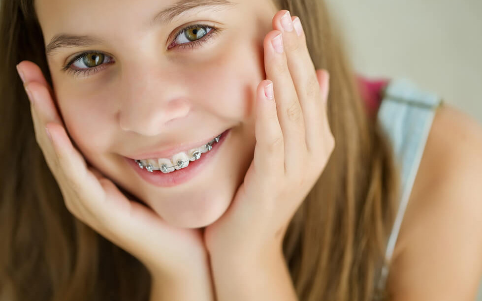 aparelho ortodontico infantil dentista Aparelho Fixo Metálico Bráquete