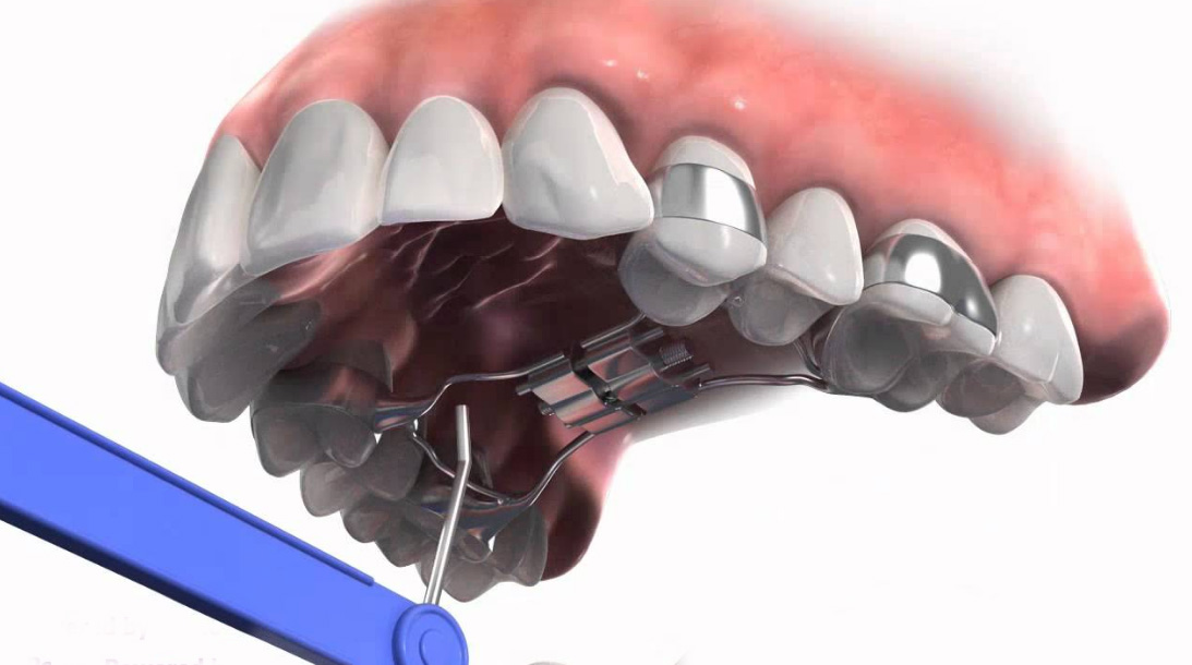 aparelho ortodontico infantil dentista Disjuntor Hyrax E Hass