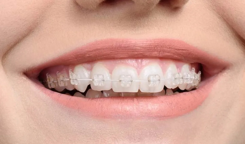 aparelho ortodontico infantil dentistaAparelho Fixo Estético Porcelana E Safira