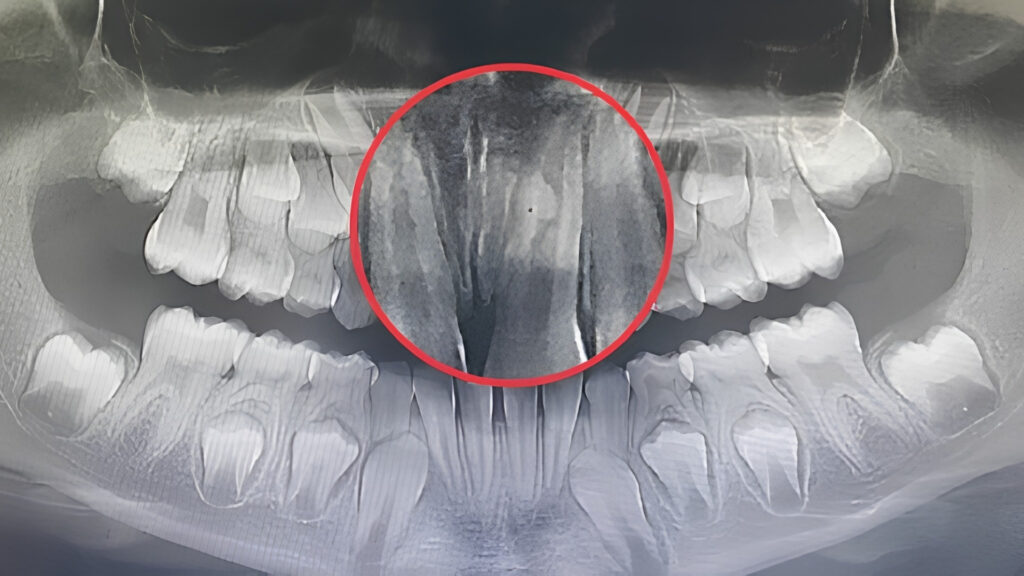 Radiografia Mesiodens
