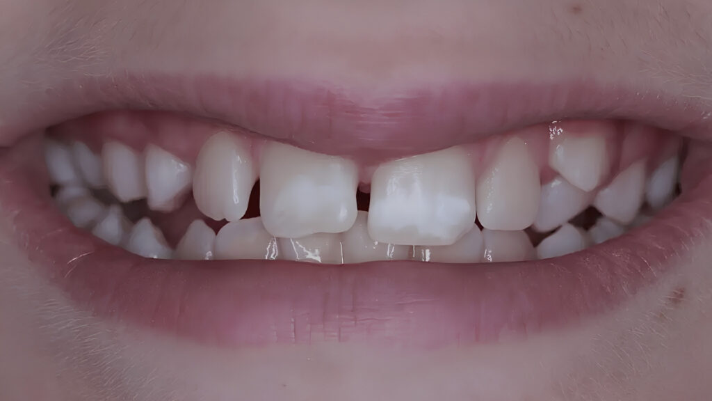 O que é a Microabrasão Dentária