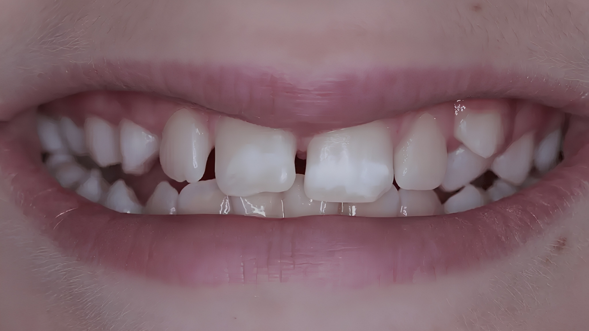O que é a Microabrasão Dentária