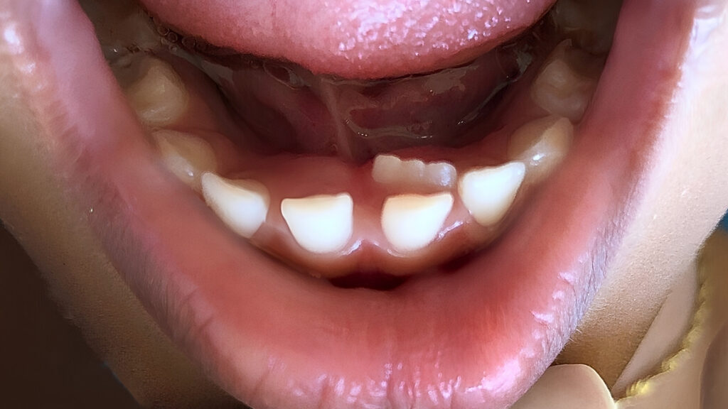 Como suspeitar de um dente de leite anquilosado?