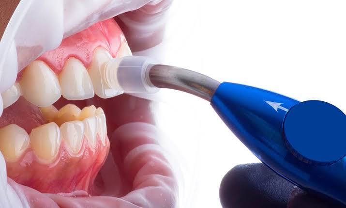 Vantagens da microabrasão dentária na infância