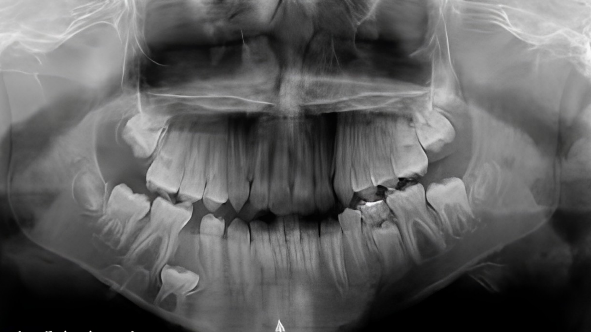 Tratamentos para dente de leite anquilosados