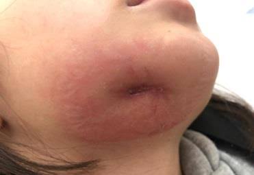 Diagnóstico e tratamento de urgência da celulite facial em crianças por infecção dentária