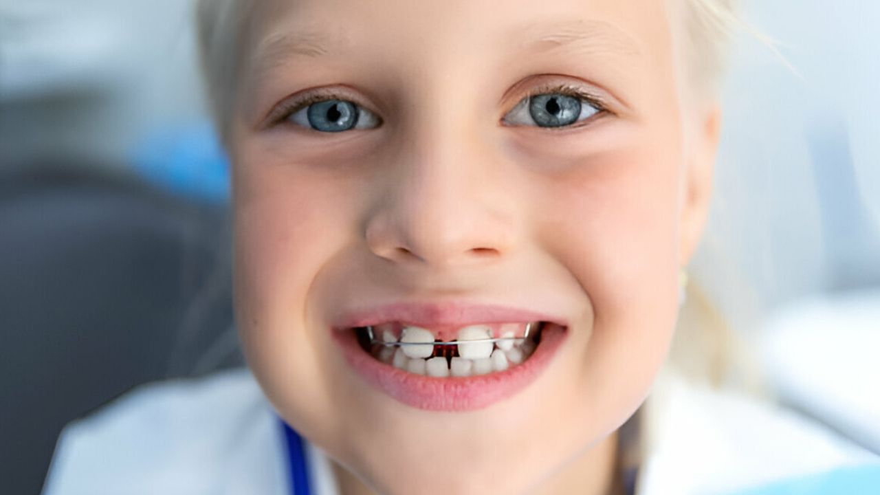 Ortodontia Preventiva e Interceptativa Diastema